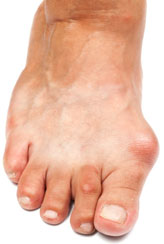 Bunions Treatment | Hammertoes Treatment | Sports Injuries Treatment | Upper West Side 