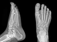 Foot and Ankle X-Rays | Upper West Side 